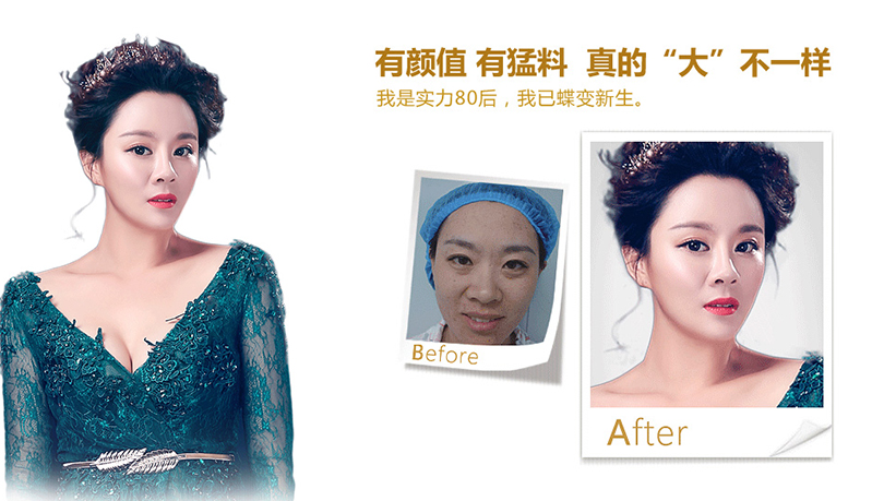 黔南脂肪移植、隆鼻